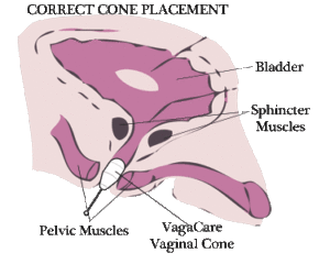 correct-cone-placement-small
